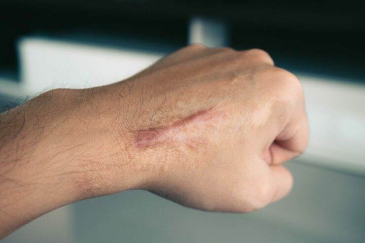 Toda cicatriz é um dano estético?